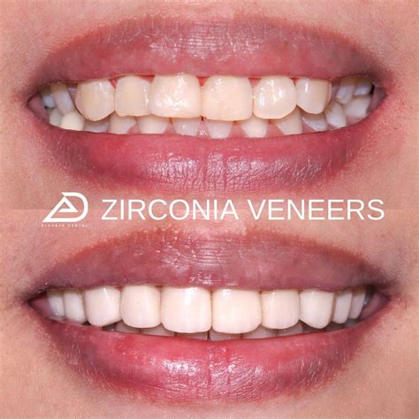 composite veneers near me|Veneers Price In The Philippines: Elevate Dental.